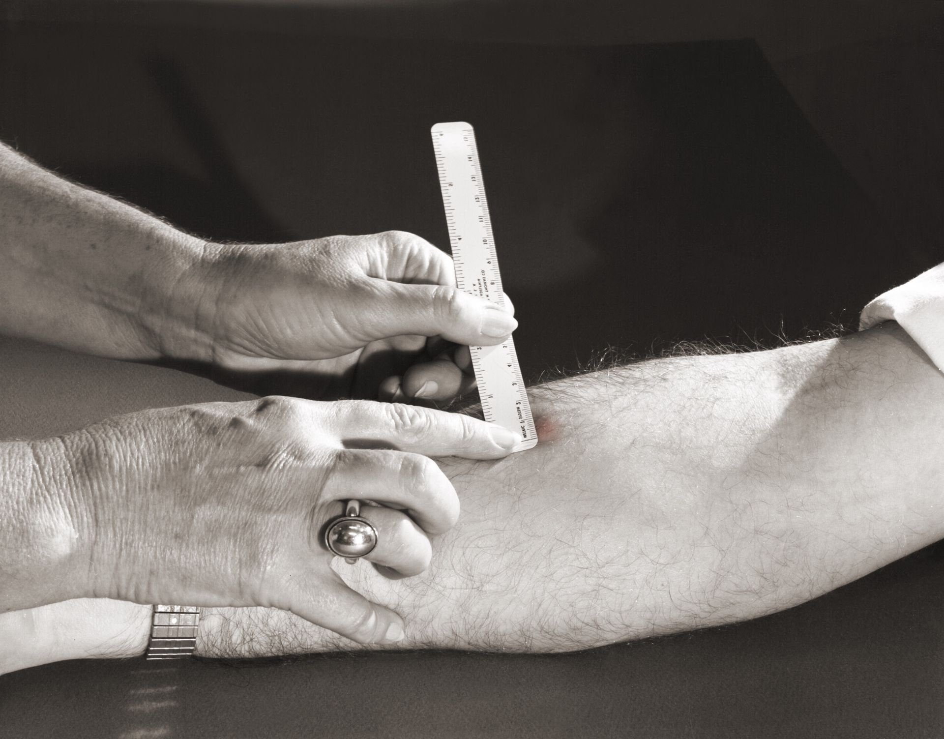A close-up, black-and-white image shows one person using a ruler to measure a raised area on another person’s forearm. The forearm rests on a flat surface, and the person measuring is gently pressing on the skin with one hand while holding the ruler upright with the other. Both individuals are partially visible, with attention focused on the interaction between the hands and the arm.