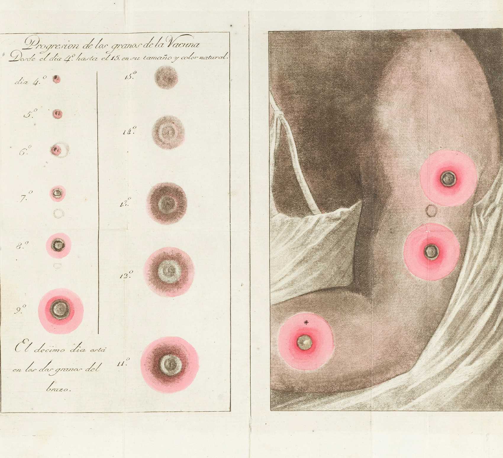 Illustration of smallpox vaccination scars